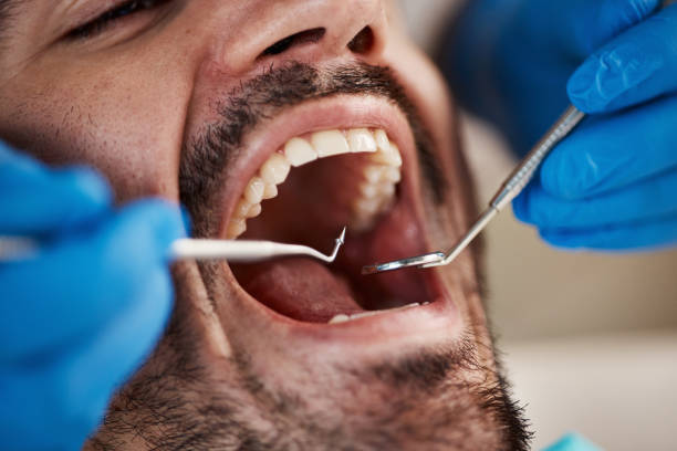 Best Emergency Dentist for Lost Fillings or Crowns in Cold Spring Harbor, NY